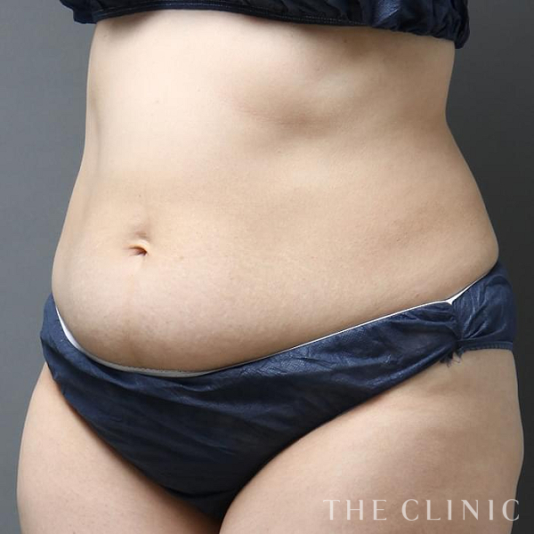 腹部の360脂肪吸引®（44歳女性）の術前写真