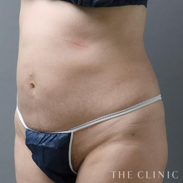 腹部の360脂肪吸引®（44歳女性）の術後写真