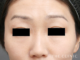 症例写真 / マイクロCRF注入(顔の脂肪注入) 術後