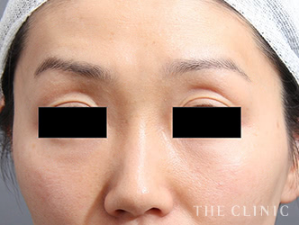 症例写真 / マイクロCRF注入(顔の脂肪注入) 術前