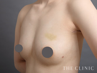 症例写真 / コンデンスリッチ豊胸 術後