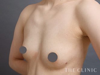 症例写真 / コンデンスリッチ豊胸 術前