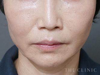 症例写真 / コンデンスリッチ豊胸 術後