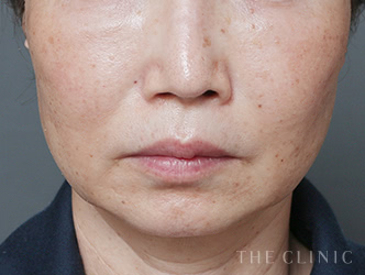 症例写真 / コンデンスリッチ豊胸 術前