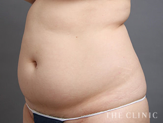 症例写真 / ベイザー脂肪吸引 術前