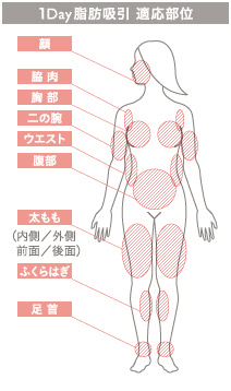 1Day脂肪吸引(日帰りの脂肪吸引)の施術2