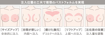 アクアフィリング豊胸の施術2