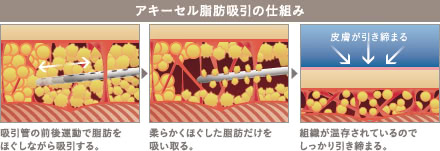 アキーセル脂肪吸引の施術1