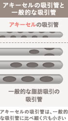 アキーセル脂肪吸引の施術2