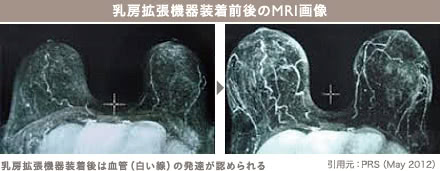 コンデンスビブラ豊胸の施術2