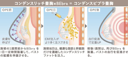 コンデンスビブラ豊胸の施術4
