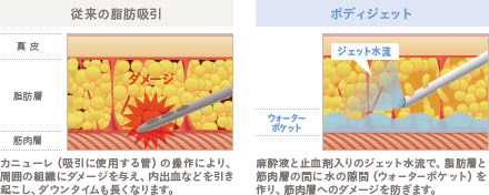 ボディジェット脂肪吸引の施術1