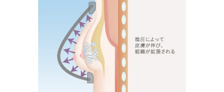 BRAVA(ブラバ)豊胸の施術1