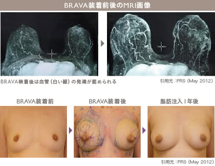 BRAVA×コンデンスリッチ豊胸の施術2