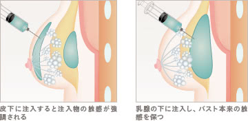 豊胸ヒアルロン酸注入(プチ豊胸)の施術1