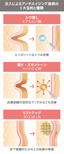 3Dセルリフト(切らないフェイスリフト)の施術2