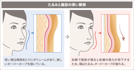 3Dセルリフト(切らないフェイスリフト)の施術2
