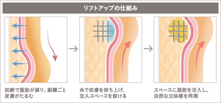 3Dセルリフト(切らないフェイスリフト)の施術3