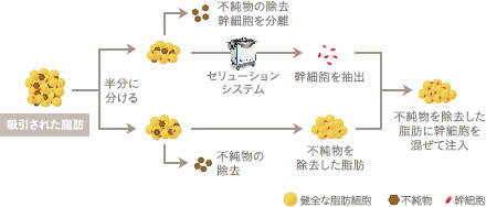 セリューション豊胸の施術3