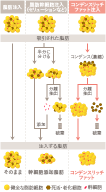 コンデンスリッチボディ(脂肪注入)の施術2
