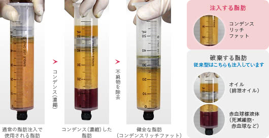 脂肪から不純物を取り除いて注入します