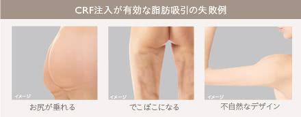 コンデンスリッチボディ(脂肪注入)の施術1