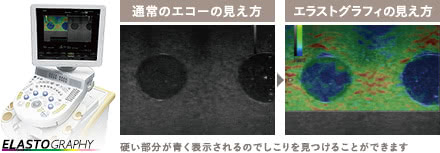 エコー検査の施術4