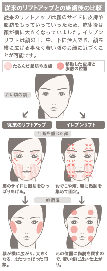 イレブンリフト(糸のフェイスリフト)の施術4