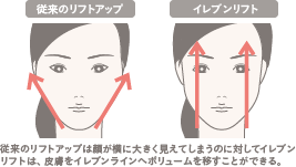 イレブンリフト(糸のフェイスリフト)の施術1