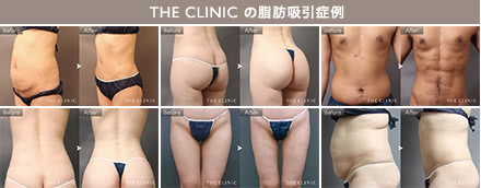 脂肪吸引カウンセリングの施術3