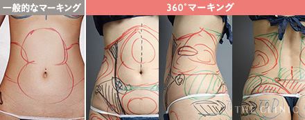 脂肪吸引カウンセリングの施術5