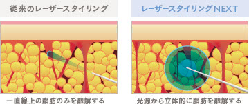 レーザースタイリングNEXTの施術1