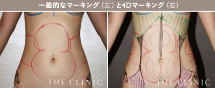 4Dマーキングシミュレーションの施術3