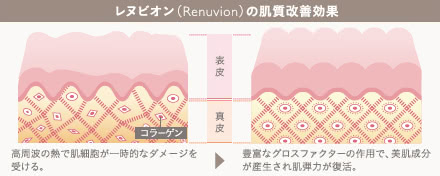 レヌビオンの施術2