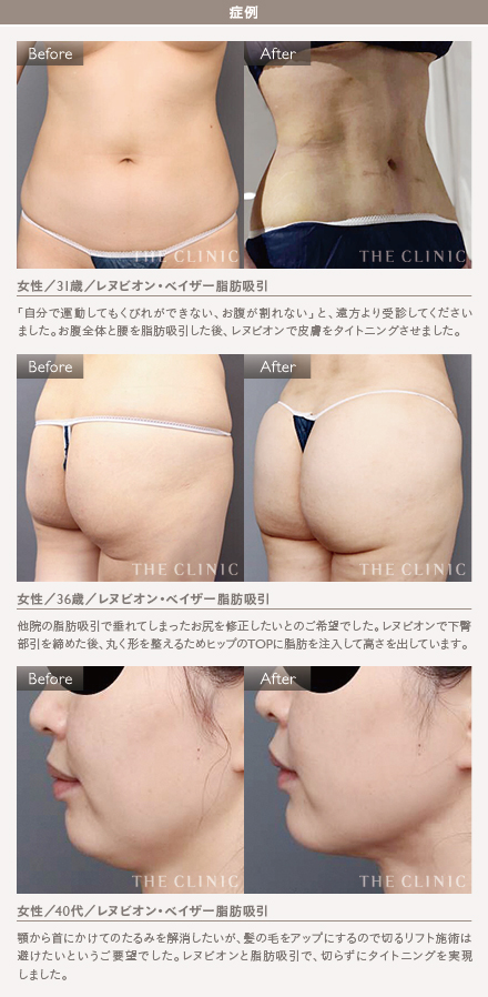 レヌビオンの施術4