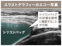 乳がん後の乳房再建リタッチの施術3