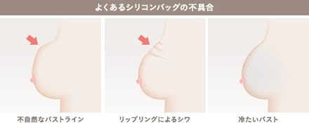 乳がん後の乳房再建リタッチの施術1