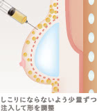 乳がん後の乳房再建リタッチの施術2