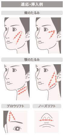 シルエットソフト(糸のフェイスリフト)の施術2