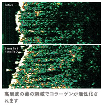 サーミ スムースの施術3