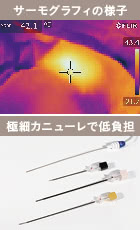 サーミタイト(たるみ改善)の施術2