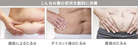 タミータック4D(お腹のたるみ解消)の施術1