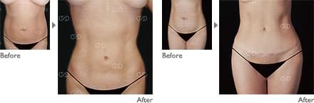 タミータック4D(お腹のたるみ解消)の施術2