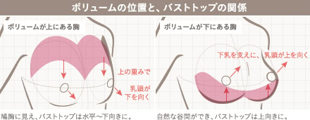 アンダーブーブ豊胸(下乳形成)の施術1