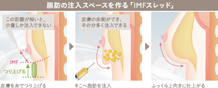 アンダーブーブ豊胸(下乳形成)の施術4