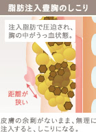 アンダーブーブ豊胸(下乳形成)の施術5