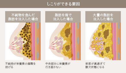 豊胸脂肪注入後のしこり