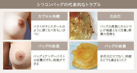 シリコンバッグ豊胸のお悩み