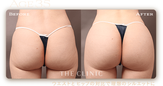 35歳 HIP MAKE by 360脂肪吸引®の症例 ウエストとヒップの対比で理想のシルエットに