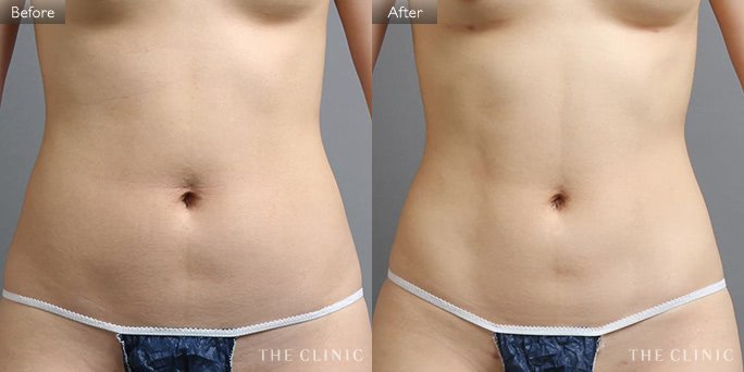 腹部(女性/27歳)4Dリポの症例画像